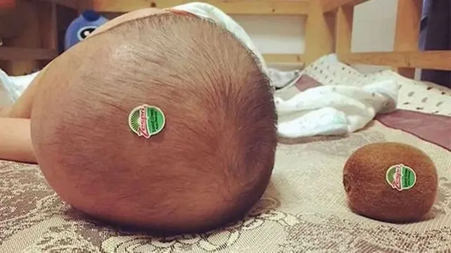 Kepala bayi mirip buah kiwi