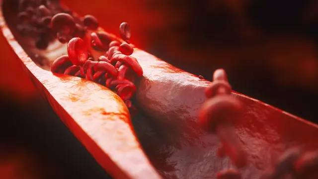 Aterosklerosis