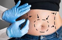Kenali Bahaya Sedot Lemak Turunkan Berat Badan Secara Instan, Risikonya Tak Main-Main