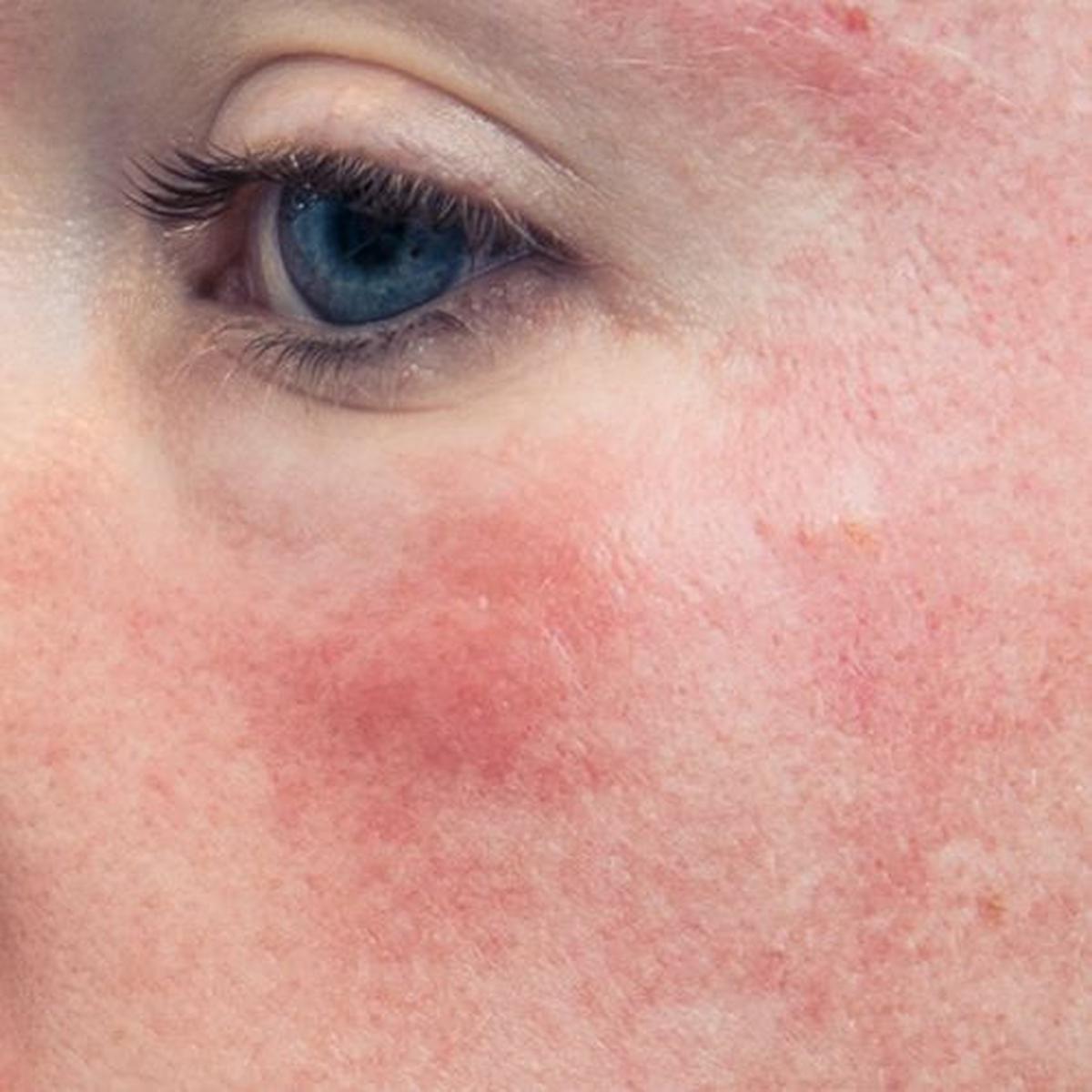 Jangan Abaikan Skin Barrier! Ini Alasan Mengapa Kulit Anda Membutuhkannya