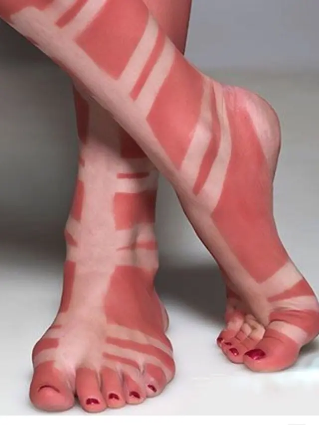 Sunburn Tattoo/Art