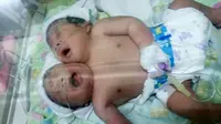 Orangtua bayi perempuan berkepala dua baru saja terkena penggusuran PKL di kawasan Gresik Kota Baru (GKB). (Liputan6.com/Dian Kurniawan)