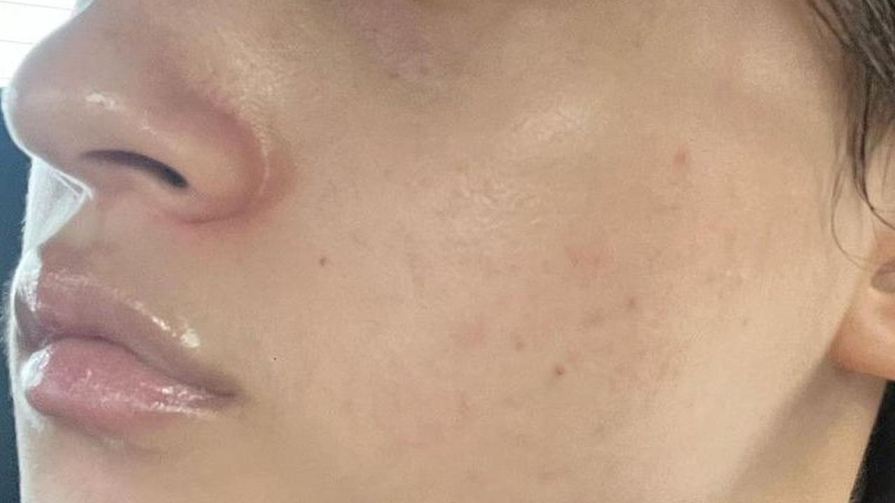 Namun, jerawat yang dimiliki oleh Megan pun cukup parah karena kerap terpapar oleh makeup akibat pekerjaannya. Belum lagi dengan jam tidur dan pola makan tidak teratur yang menyebabkan wajahnya mudah breakout.