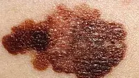 Melanoma, Kanker Kulit yang Paling Berbahaya