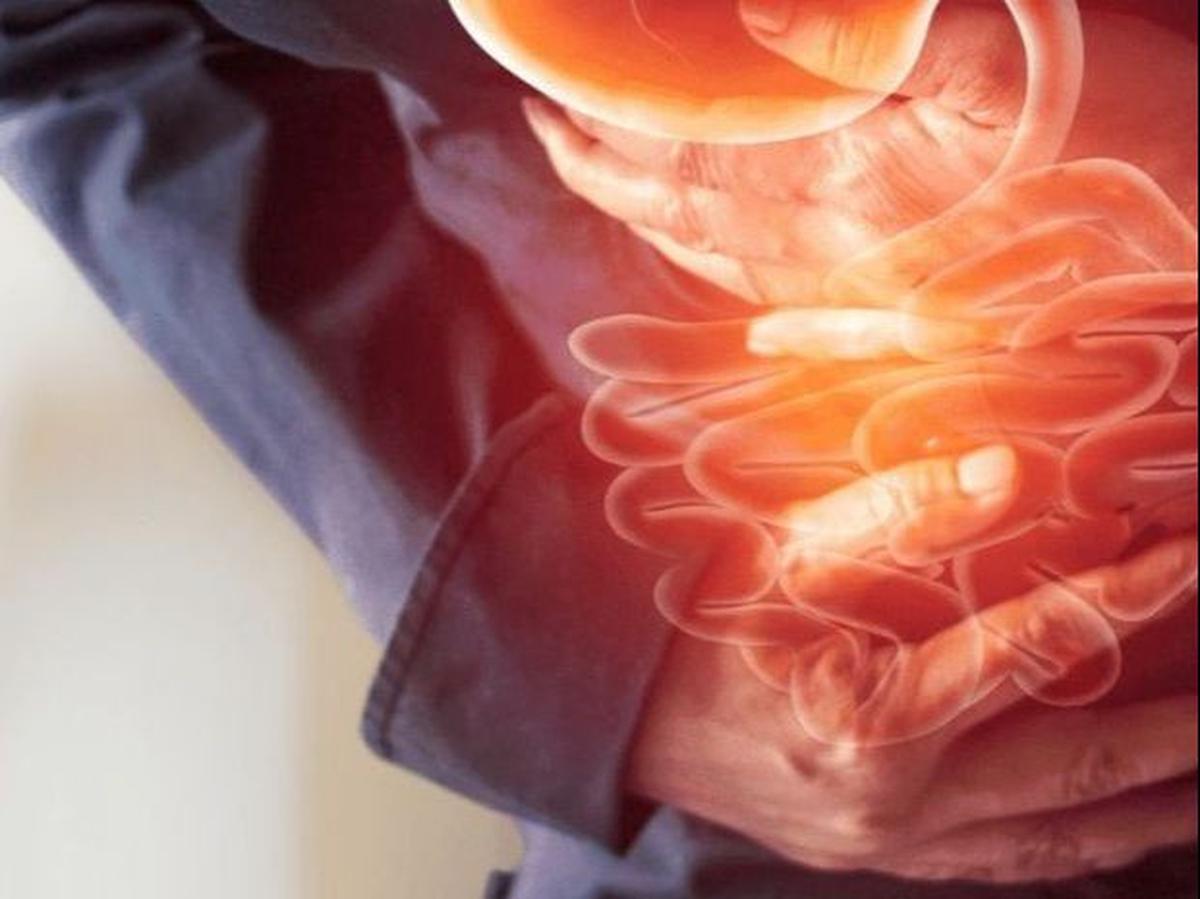 Cara Mengatasi Gastroparesis