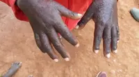 Seorang anak laki-laki mengulurkan tangan yang terkena kudis, penyakit menular yang disebabkan oleh tungau kecil yang masuk ke dalam kulit. (Foto:MSF)