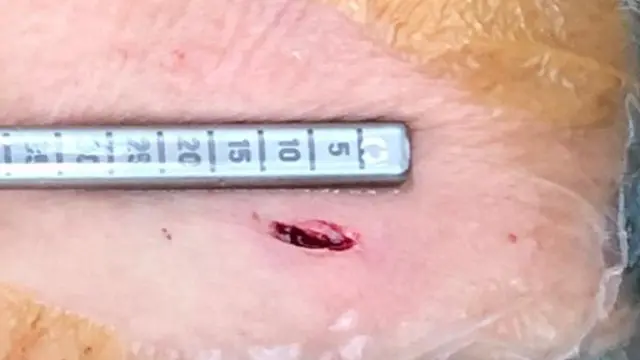 Teknik minimal invasive yang hanya memerlukan sayatan kecil.