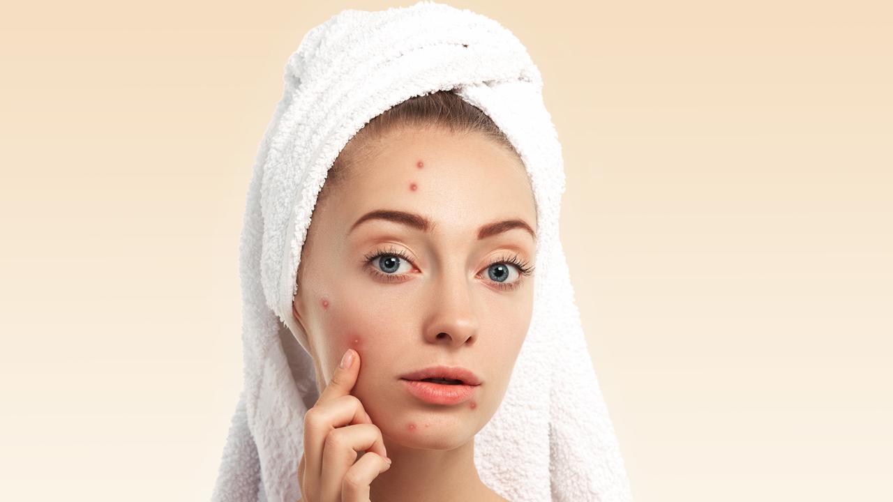 Jerawat Hilang Tanpa Skincare? Ini 9 Cara Alami yang Bisa Dicoba