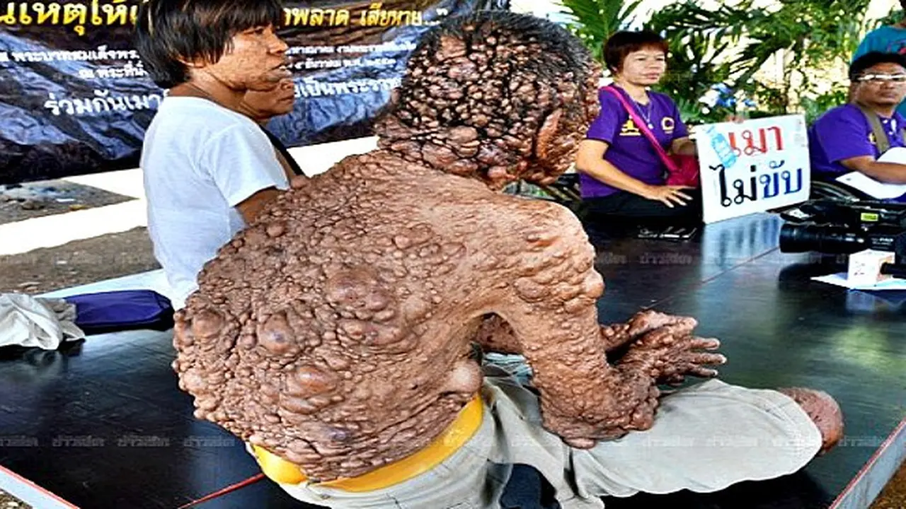 Tumor