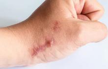 Pengertian dan Penyebab Keloid, ini Cara Efektif Mencegahnya
