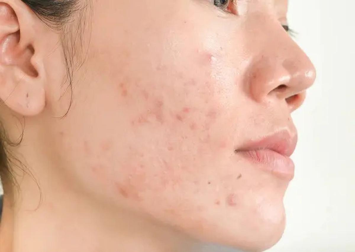 Perawatan Alami untuk Jerawat, Cara Efektif dengan Menggunakan Masker Oatmeal dan Madu