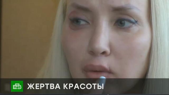 Ingin Cantik, Wanita Ini Nekat Menginjeksi Wajahnya dengan Zat Asing