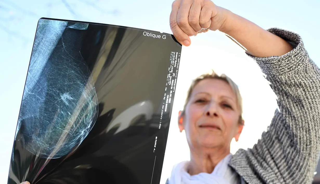 Sylvie Anane (54) menunjukkan mammogram miliknya yang terdapat tumor di rumahnya di Fos-sur-Mer, Prancis (10/10). Sylvie Anane mengalami penyakit arteri koroner pertamanya pada usia 38 tahun. (AFP Photo/Boris Horvat)