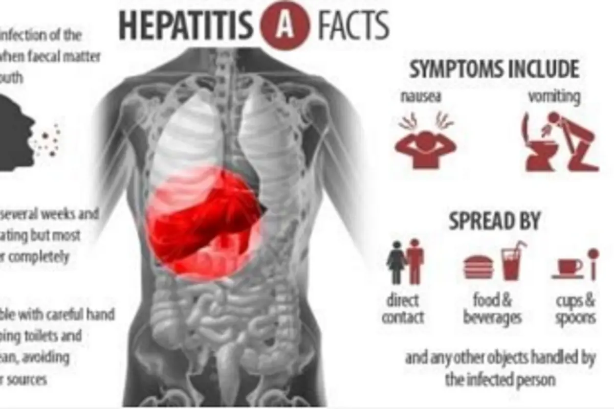 Hepatitis A