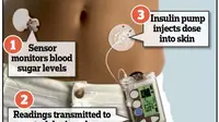Alat yang sekilas mirip dengan iPod, akan diikat ke dalam pakaian pasien dengan monitor kecil dan pompa yang dipasang di kulit si pasien.