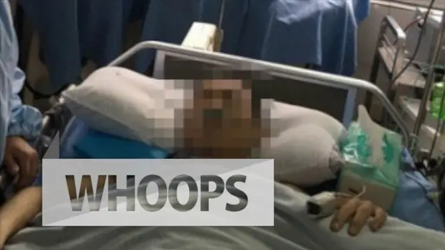 Tumor Seberat 15 Kg Berhasil Diangkat dari Perut Pria Ini
