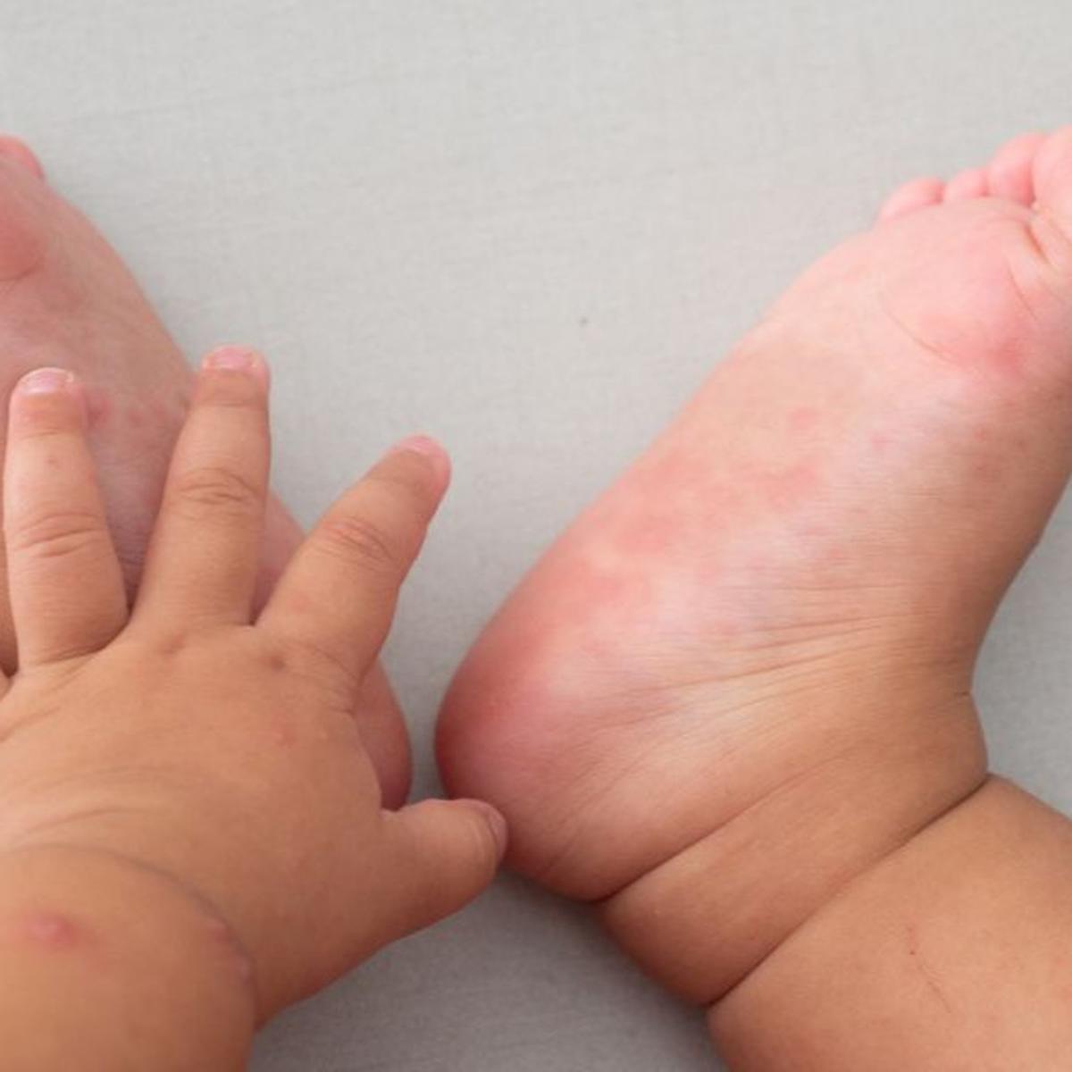 Waspada Penularan Flu Singapura Pada Anak Cenderung Meluas Saat Mudik