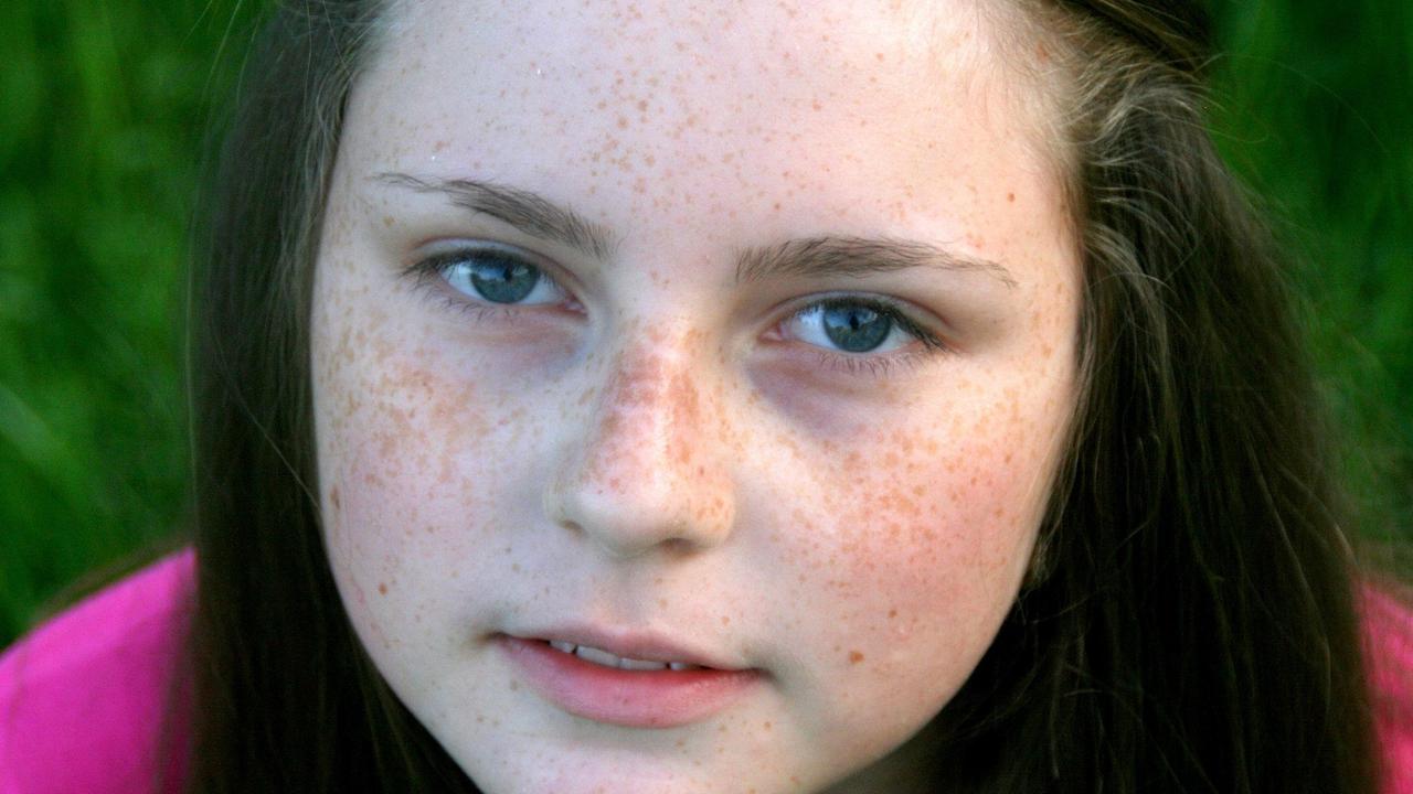 Waspadai Freckles di Wajah: Simbol Kecantikan atau Sinyal Masalah Kesehatan? Ini Penjelasan Medisnya