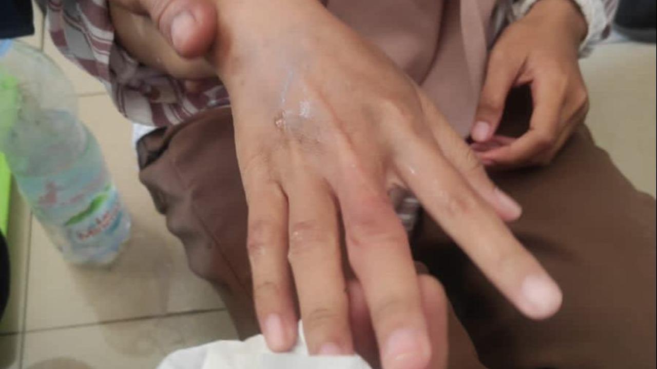Dalam waktu kurang lebih 10 menit, evakuasi selesai dilakukan. Jari tengah mahasiswi ini pun berhasil dikeluarkan tanpa melukai jari tersebut.