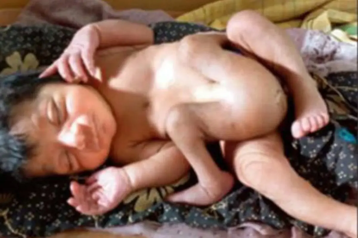 Bayi dengan Empat Kaki dan Dua Kelamin Buat Geger Warga