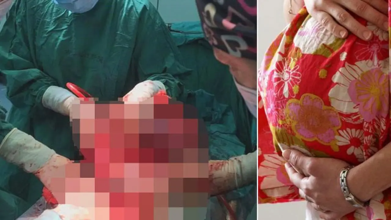 Tumor 15 kg dari perut seorang wanita di China. (Shanghai General Hospital)
