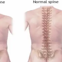 Skoliosis (via backinbalanceclinic.ca)