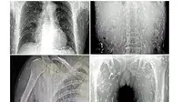 Gambar x-ray penikmat sashimi.terinfeksi cacing pita. (Youtube)