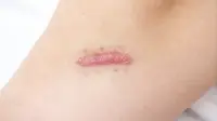 Keloid adalah Jaringan Parut Berlebih, Begini Cara Mengatasi dan Pencegahannya