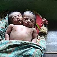 Seorang ibu di Bangladesh melahirkan bayi berkepala dua. Bayi tersebut harus saling berbagi organ tubuh. 