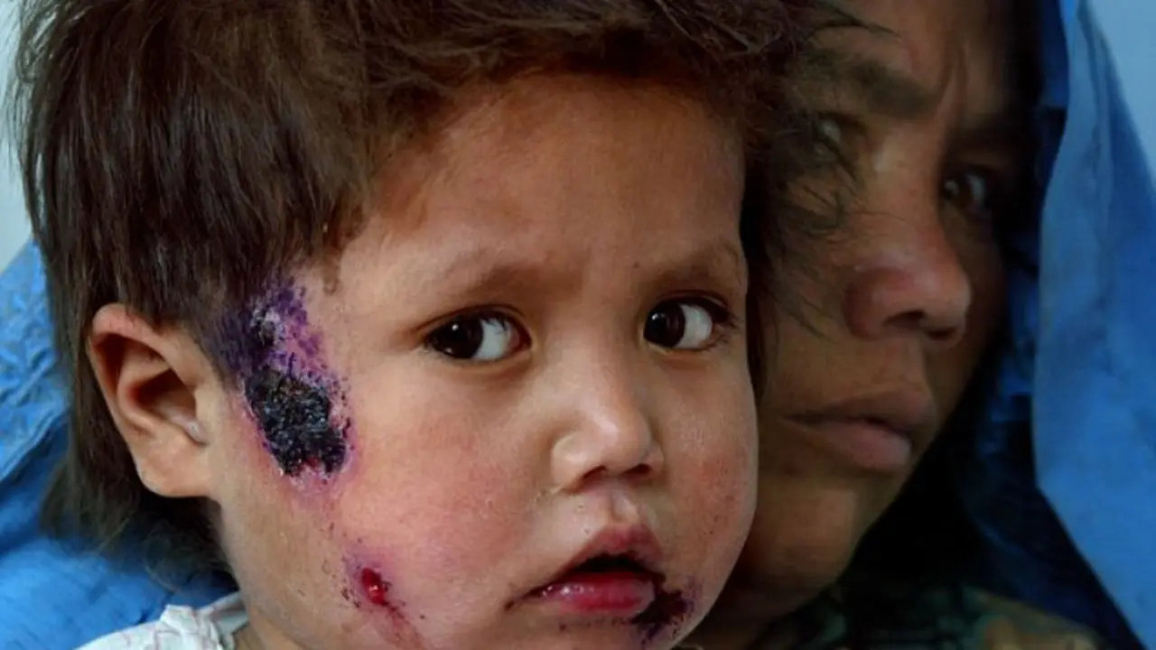 500 Penduduk Suriah Derita Penyakit Leishmaniasis