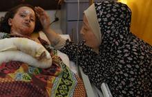 70 Persen Korban Luka Bakar di Gaza adalah Anak-Anak, Sebagian Besar di Bawah Usia 5 Tahun