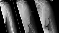 Pemindaian sinar-X memperlihatkan kronologi hilangnya tulang lengan seorang perempuan (kiri ke kanan: bulan ke 12, 15, dan 18). (BMJ Case Reports)