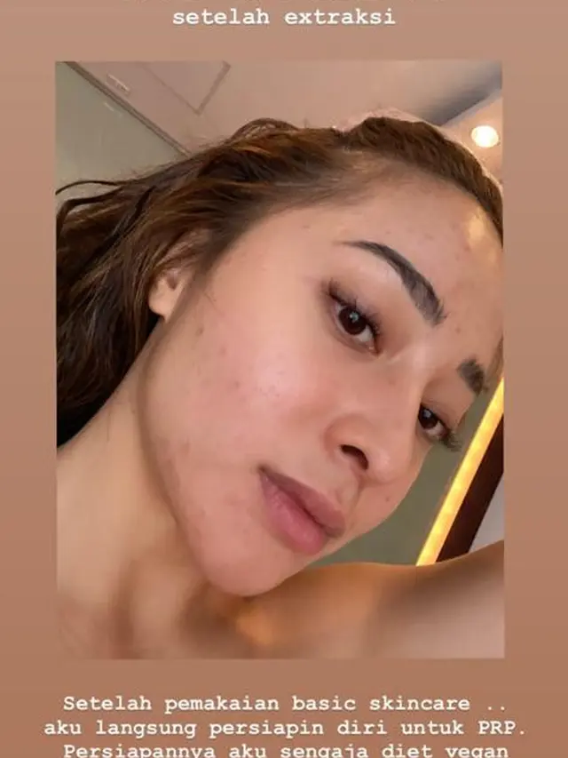 Unggah Foto Berjerawat, Ini 6 Potret Nikita Willy Tampil Natural