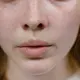 Penjelasan terkait Melasma oleh Kalbe, mulai dari penyebab hingga cara penyembuhannya. (pexels.com/Tima Miroshnichenko)