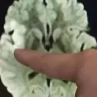 Seorang wanita mengalami pembekuan darah di otak gara-gara smartphone. (Sumber Foto: NextShark)