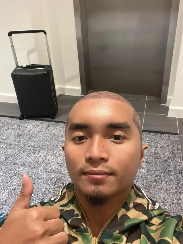 7 Potret Taqy Malik yang Kini Botak Usai Tanam Rambut di Turki