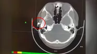 Sering Mengeluh Sakit, Ternyata Peluru Bersarang di Kepala Pria Ini Selama 20 Tahun