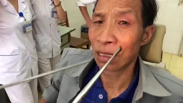 Suka Minum Air Sungai Tanpa Dimasak, Lintah Bersarang di Hidung Pria Ini