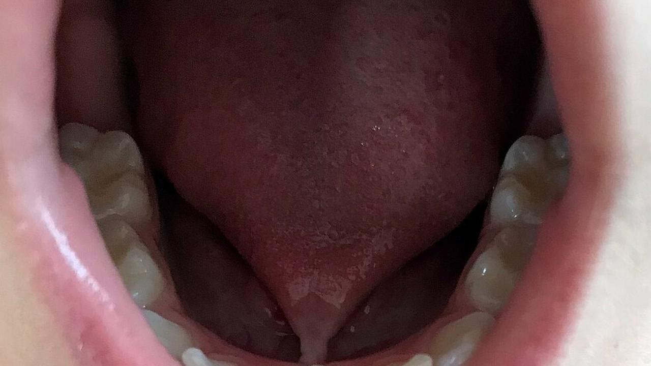 Ilustrasi Tongue Tie