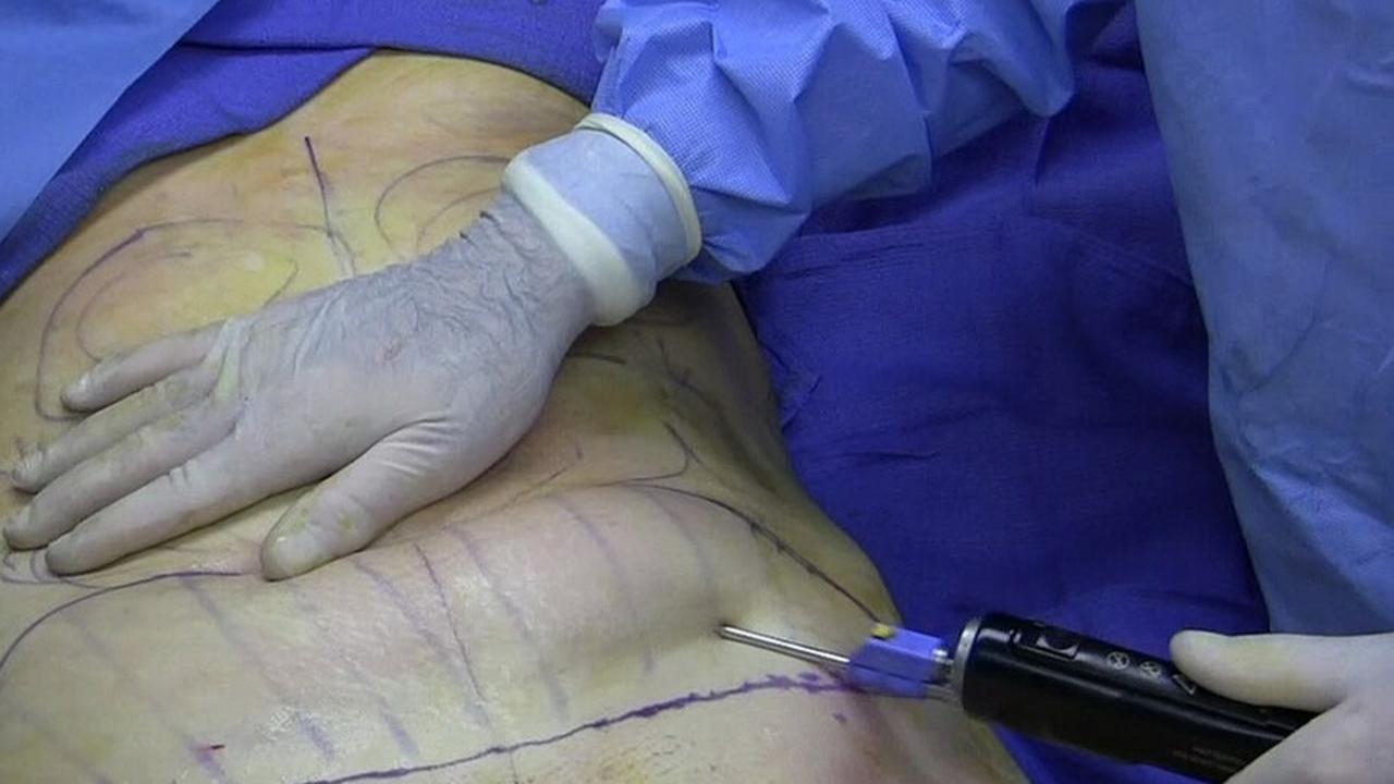 Dokter Bedah Plastik Ingatkan Bahwa Sedot Lemak Bukan Cara Instan Turunkan Berat Badan