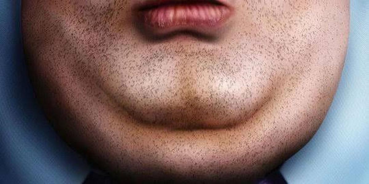 double chin
