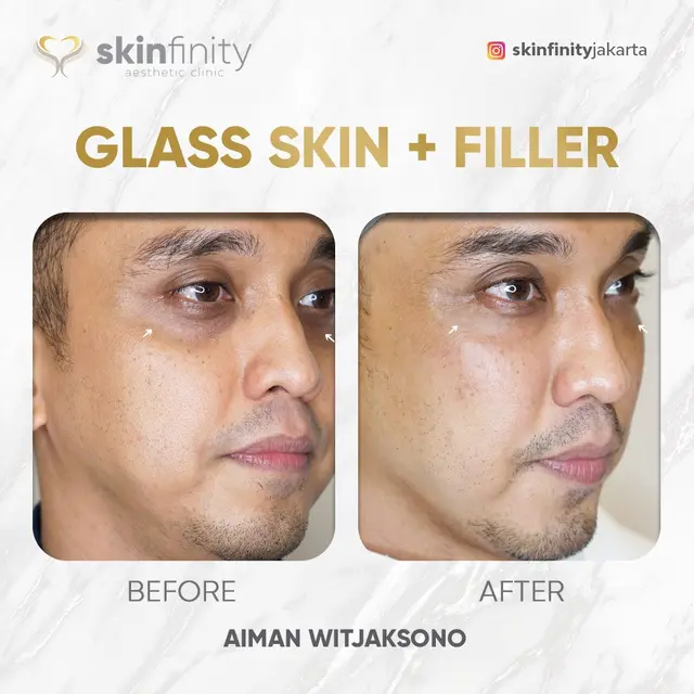 Aiman Witjaksono setelah dan sesudah perawatan.