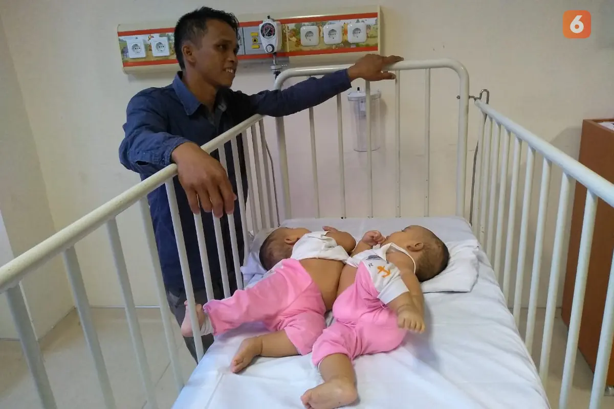 Bayi Kembar Siam