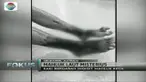 Kaki seorang remaja lelaki ini tampak mengerikan setelah digigit oleh makhluk-makhluk kecil di laut. Makhluk apa itu?