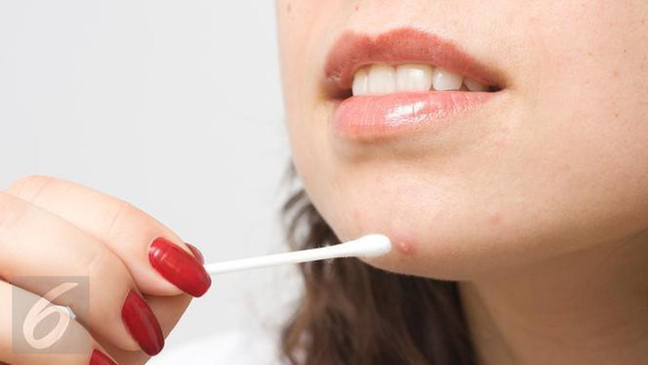 5 Tanda Anda Berurusan dengan Jerawat Hormonal