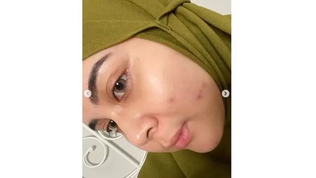 6 Seleb Ini Pernah Unggah Foto saat Wajah Berjerawat, Akui Tak Malu