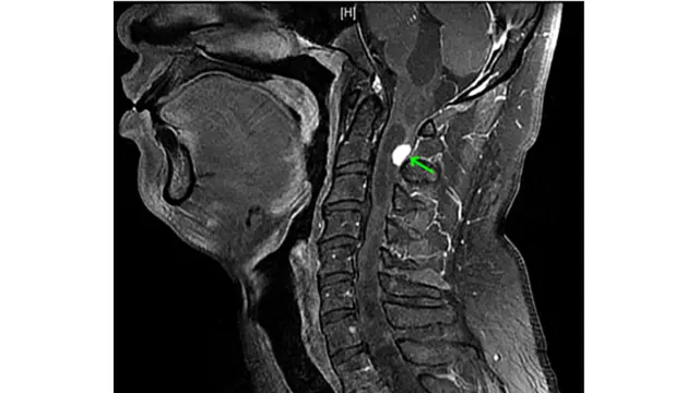 Cegukan Terus Menerus, Ternyata Ada Tumor Besar di Leher Pria Ini