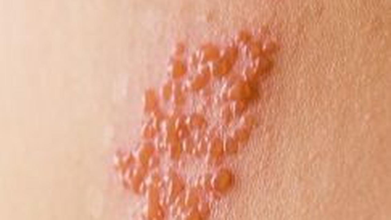 Mitos Dompo Alias Herpes Zoster yang Harus Diketahui, Simak Penyebabnya