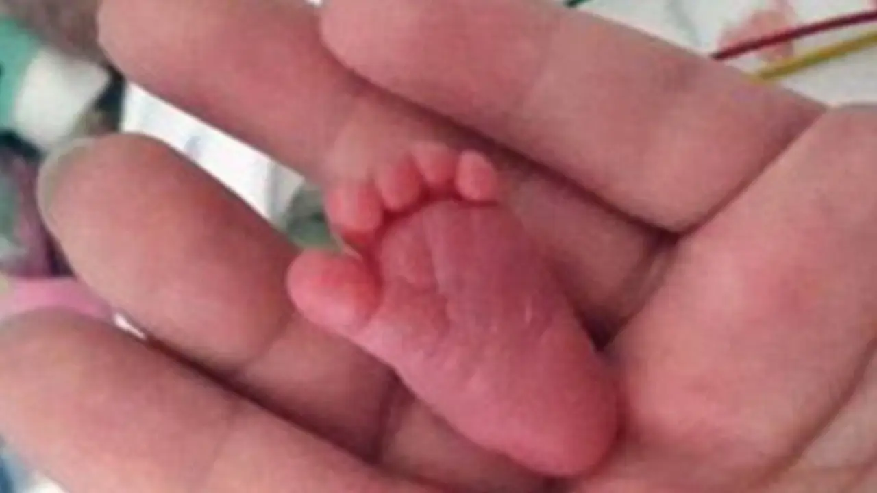 Bayi Paling Mungil di Dunia, Beratnya Cuma 0,2 Kilogram