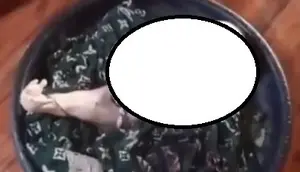 Viral Bayi dengan Kaki Menyatu di Sumatera Selatan, Begini Penjelasannya